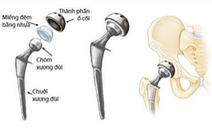 Khớp háng nhân tạo - cứu cánh giúp bệnh nhân gãy cổ xương đùi tránh tàn phế