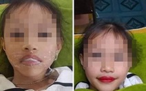 Bố thẩm mỹ phun môi cho con gái 5 tuổi: 'Tôi chiều con nên làm cho con vui thôi'