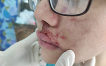 Tiêm filler vùng mặt, cô gái trẻ phải nhập viện vì nhiễm trùng