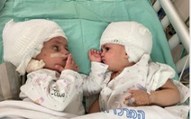 Tách thành công trẻ sinh đôi dính đầu ở Israel