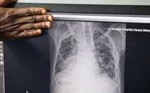 WHO báo động bệnh nhân lao tăng đột biến, 1,6 triệu người chết năm ngoái