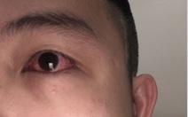 F0 bị đỏ mắt: Triệu chứng không nên chủ quan