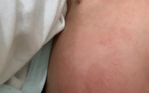 Bé bị ban đỏ trên da có phải là triệu chứng của COVID-19?