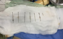 Phẫu thuật lấy 7 cây kim khâu đã gỉ sét trong lồng ngực nữ bệnh nhân