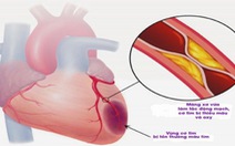 Thông tin cần biết về nhồi máu cơ tim cấp