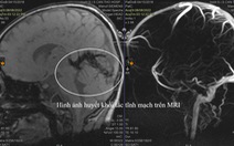 Bé trai 4 tuổi đột quỵ não được bác sĩ Cần Thơ cứu sống
