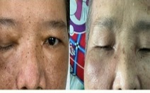 Bệnh viện Tai mũi họng TP.HCM ghi nhận nhiều người bị cốt tủy viêm xương, 6 ca tử vong
