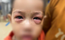 Trẻ đau mắt đỏ gia tăng, dễ lây lan thành dịch