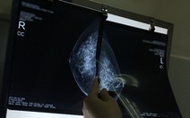 AI có thể phát hiện ung thư vú chính xác hơn 20%