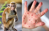 Bệnh đậu mùa khỉ gần giống bệnh thủy đậu, cần phân biệt thế nào?