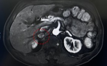 Phát hiện khối u tuyến thượng thận nhờ chụp cộng hưởng từ MRI
