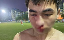 Công an xác minh vụ nam thanh niên tố bị đánh gãy mũi trên sân bóng đá phủi