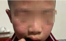 Trẻ bị phát ban, ngứa do thuốc diệt muỗi, tại sao?