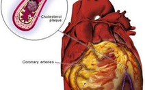 Lượng crôm thấp làm tăng nguy cơ đau tim