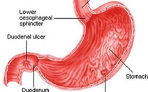 Thủng ổ loét dạ dày - tá tràng