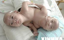 Trung Quốc: Mổ tách rời cặp song sinh dính liền