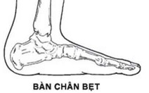 Bàn chân bẹt ở trẻ em