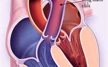 Dị tật tim bẩm sinh "còn ống động mạch"