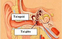 Phẫu thuật tai có biến chứng liệt mặt ?