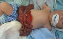 Cứu thành công bé sơ sinh có phần lớn nội tạng nằm ngoài ổ bụng
