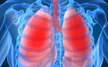 Viêm phổi cấp, bệnh nguy hiểm tính mạng