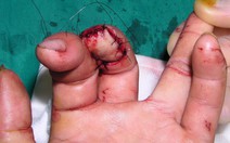 Mất da đầu ngón tay: vết thương nhỏ, hậu quả lớn