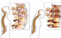 Bệnh thoát vị đĩa đệm