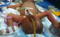 Phẫu thuật u quái cùng cụt 0,5kg ở trẻ sơ sinh