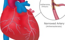 Blog bác sĩ: Bạn có bệnh tim không?