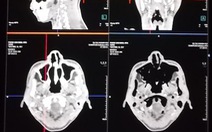 Khánh Hòa phẫu thuật thành công ca túi phình động mạch não