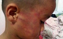 Thêm cháu bé 3 tuổi nghi bị cha đánh "bầm dập"