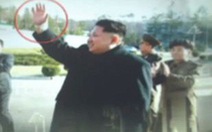 Ông Kim Jong Un  bị chấn thương cổ tay