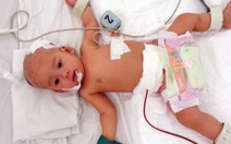 Cứu sống bé gái sơ sinh bị đa dị tật đường tiêu hóa
