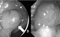 ​Điều trị ung thư đại tràng bằng nội soi
