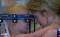 Ca phẫu thuật thần kỳ tại Úc: Nối đầu cho em bé bị nạn