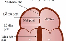 Em bé bị thông liên nhĩ lỗ thứ hai có thể chữa khỏi