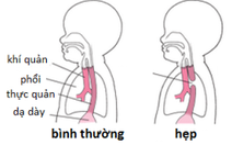 Nhiều năm thức ăn không xuống  dạ dày