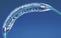 ​Khuyến cáo mới sau phẫu thuật đặt ống stent nong mạch vành