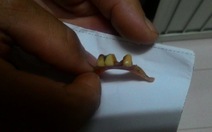 ​Nuốt hàm răng giả gây thủng đại tràng