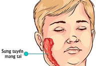 ​Chăm sóc và phòng ngừa bệnh quai bị