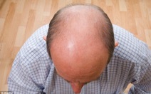 ​Sớm hói đầu liên quan tới ung thư tuyến tiền liệt