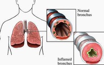 Lấy hạt dưa nằm trong  đường thở hai tuần