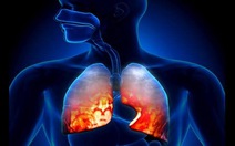 ​Những điều cần biết về bệnh viêm phổi