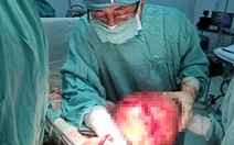 Phẫu thuật một phụ nữ u xơ tử cung hơn 5 kg