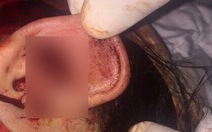 Một thiếu nữ bị 20 thanh niên đánh đập dã man, cắt tai