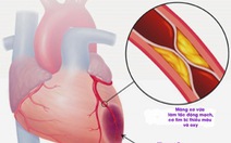 ​Nhồi máu cơ tim và cách phòng ngừa