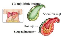 ​Phát hiện viêm túi mật cấp: chú ý dấu hiệu sớm