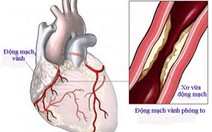 ​Bệnh động mạch vành và những điều cần biết