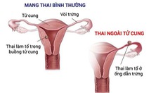 ​Những biểu hiện khi bị thai ngoài tử cung