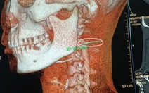 Gắp xương cá nằm 3 tháng trong cổ họng